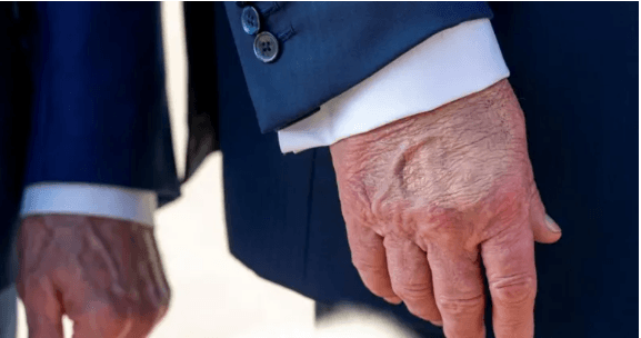 What is Trump's vein condition and how serious is it?