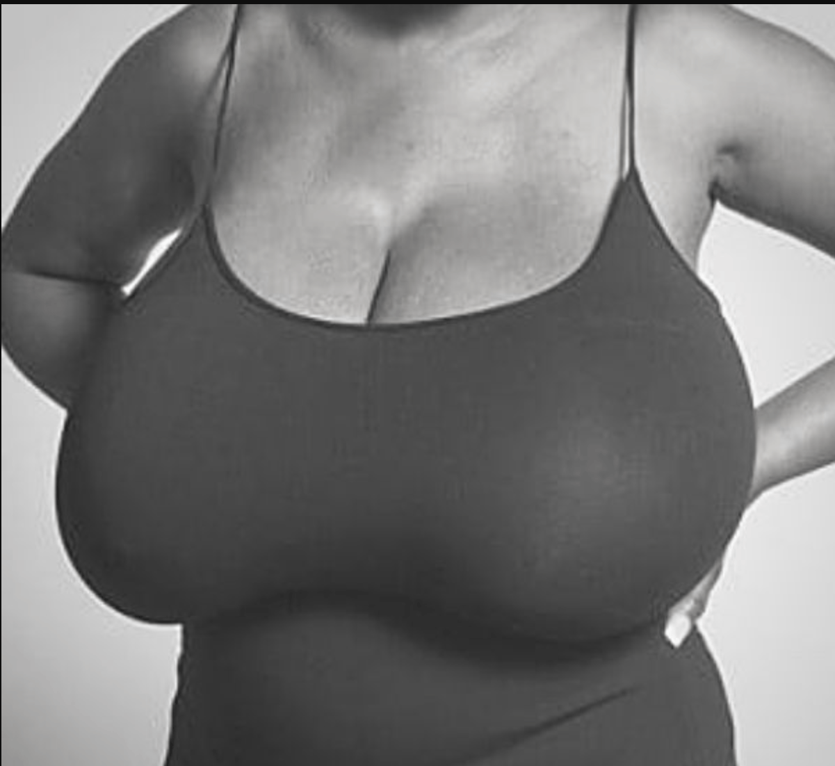 When breasts become a burden