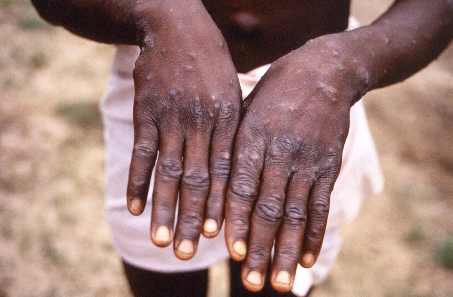 Explainer: How Mpox virus affects human body