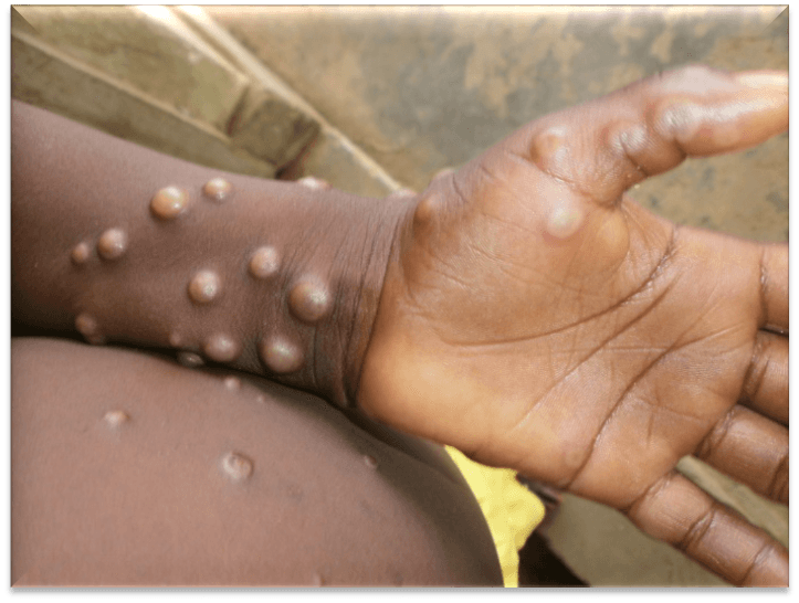 MPox cases rise to 33 – MoH