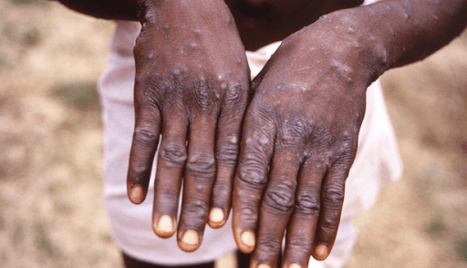 Kenya confirms one Mpox case in Makueni